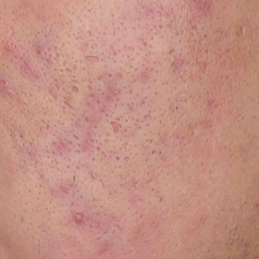 cicatriz eritematosa