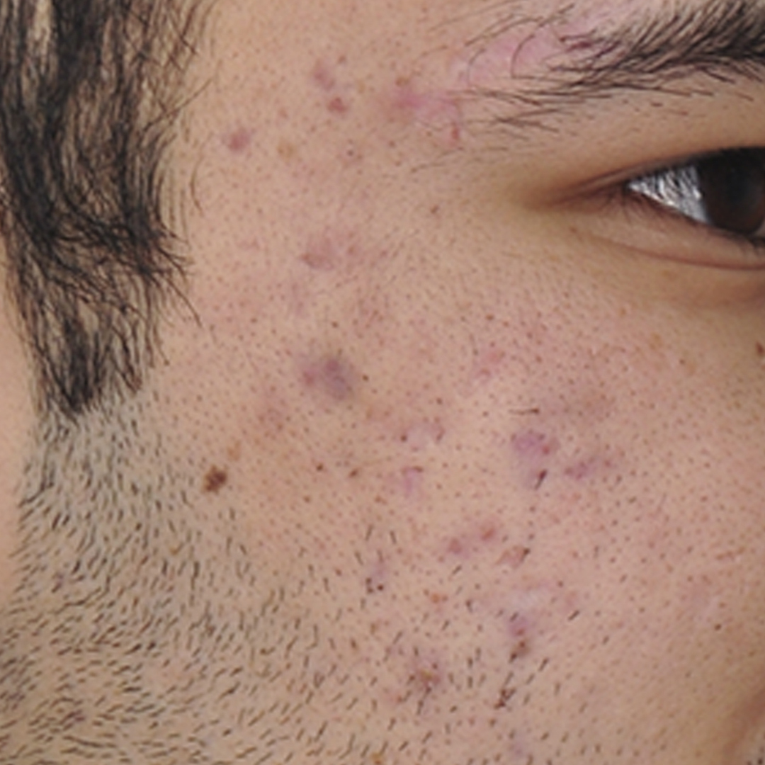 cicatrices pigmentadas