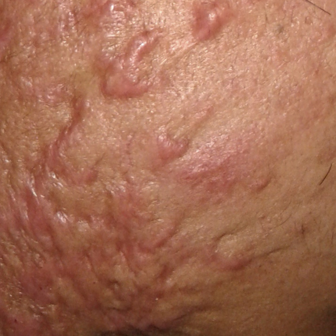 cicatrices queloideas