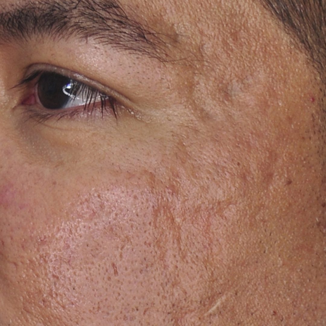 hundidas cicatrices atróficas